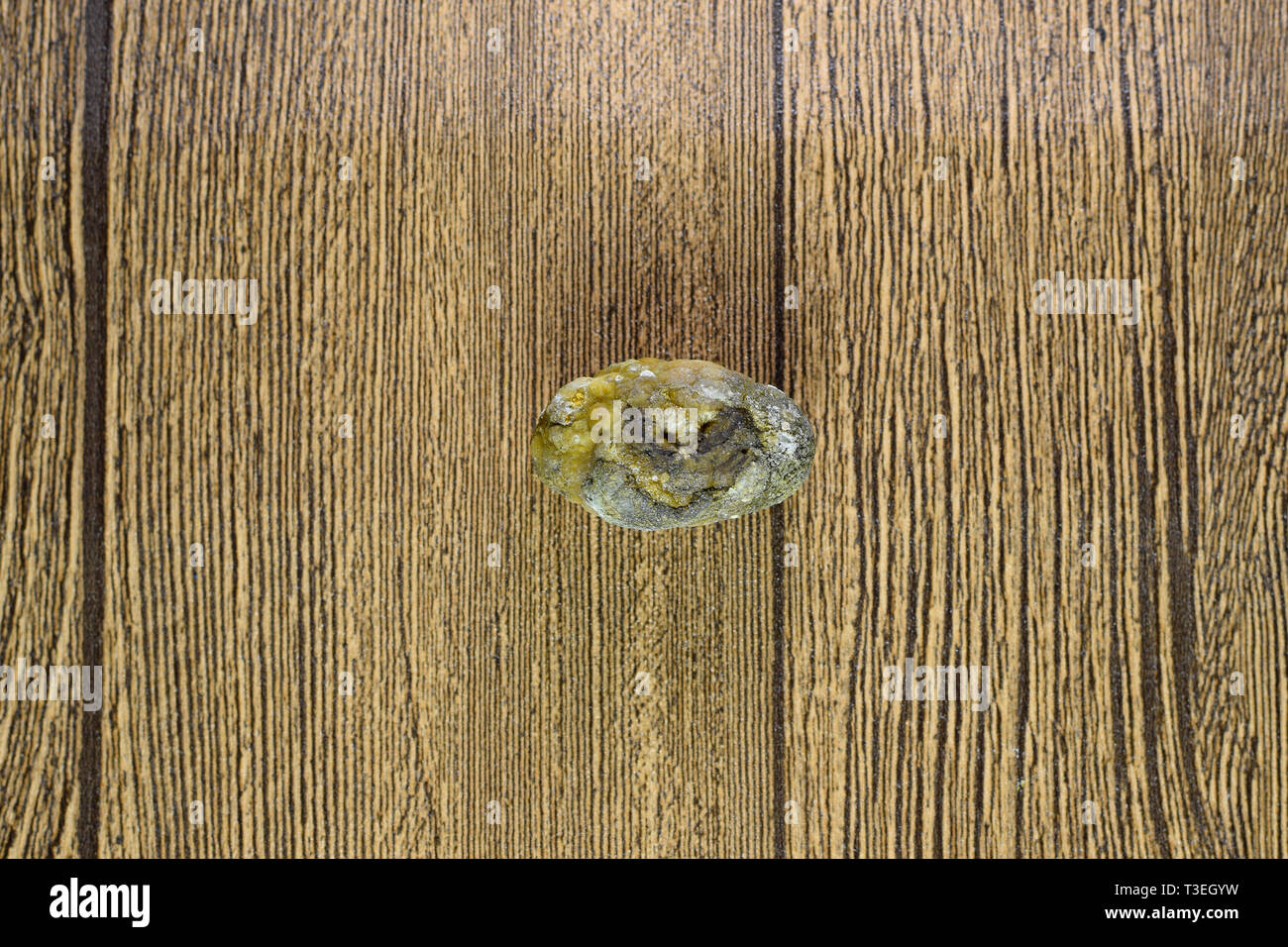 Grandi gallstone, cistifellea pietre. Il risultato dei calcoli biliari. Calcolo della composizione eterogenea Foto Stock