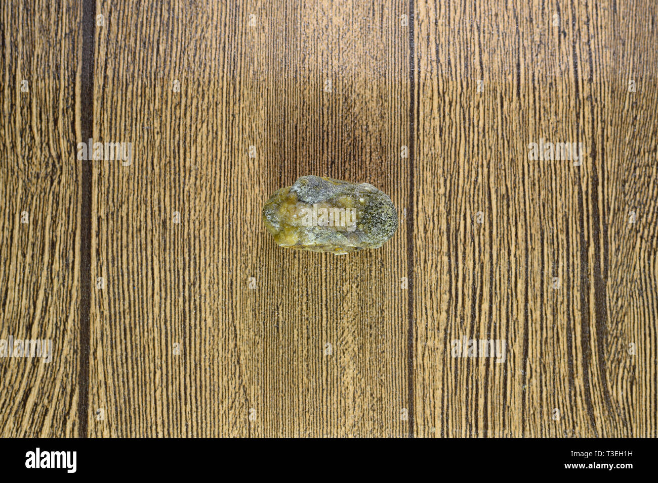 Grandi gallstone, cistifellea pietre. Il risultato dei calcoli biliari. Calcolo della composizione eterogenea Foto Stock