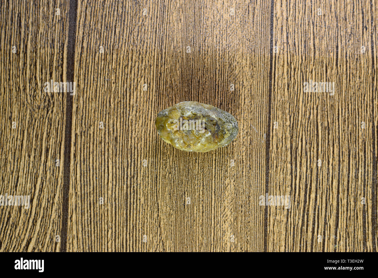 Grandi gallstone, cistifellea pietre. Il risultato dei calcoli biliari. Calcolo della composizione eterogenea Foto Stock