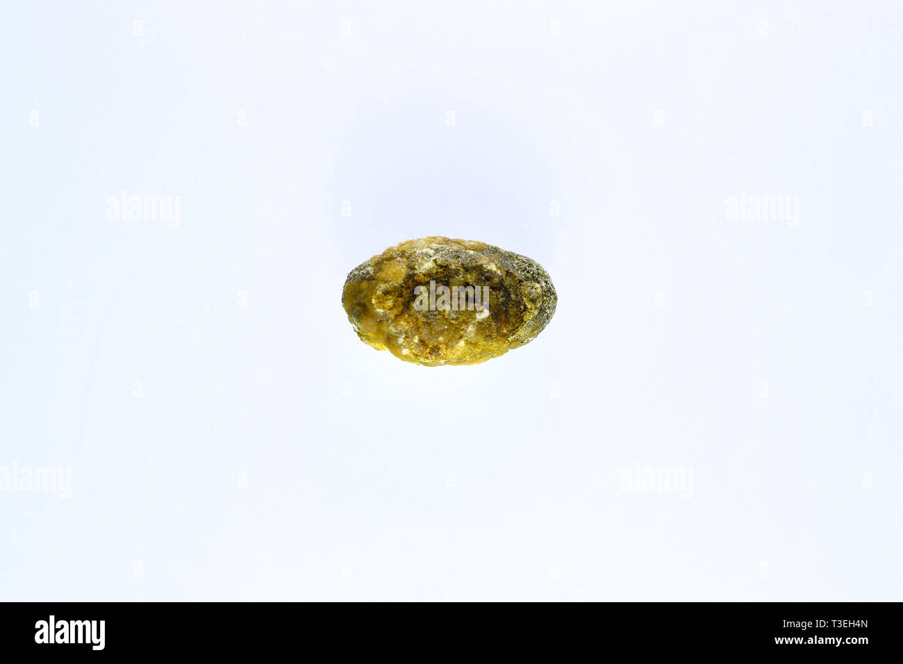 Grandi gallstone, cistifellea pietre. Il risultato dei calcoli biliari. Calcolo della composizione eterogenea Foto Stock