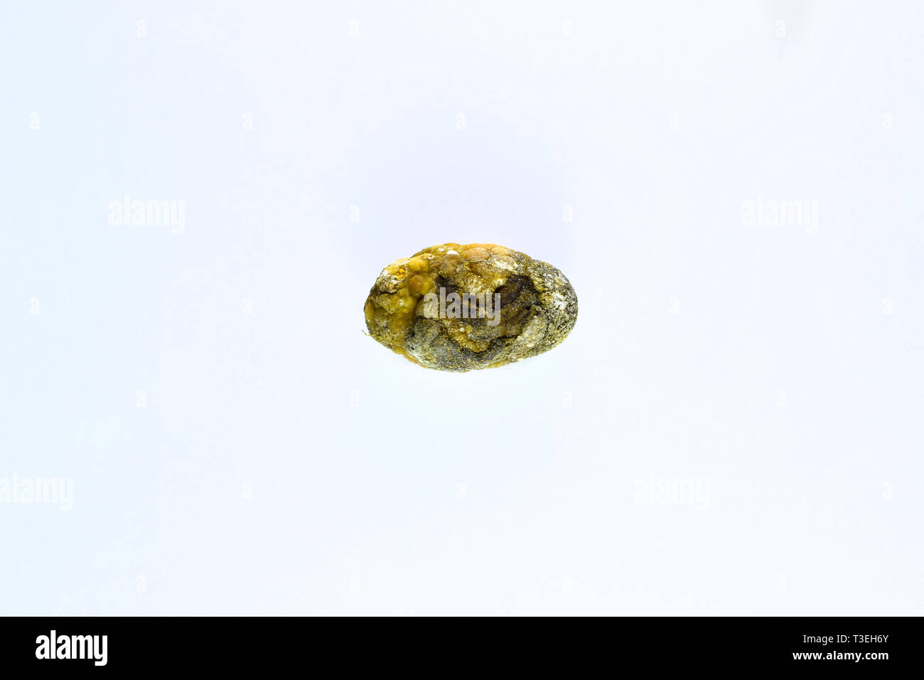 Grandi gallstone, cistifellea pietre. Il risultato dei calcoli biliari. Calcolo della composizione eterogenea Foto Stock