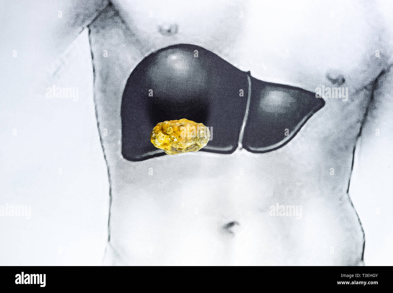 Pietra nel fegato, una immagine schematica, una grande gallstone, il risultato dei calcoli biliari. Foto Stock
