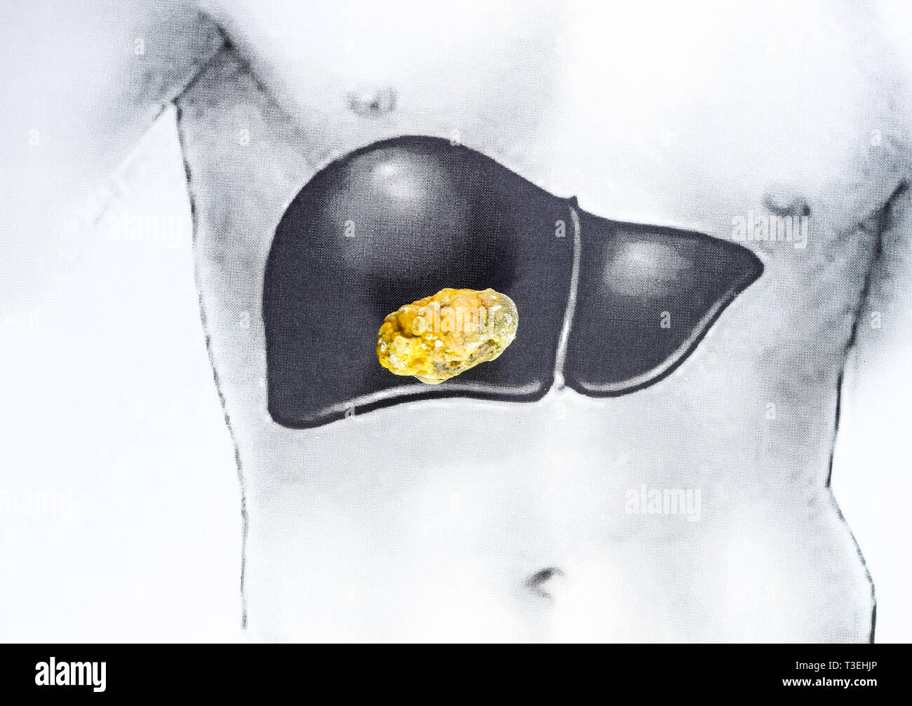 Pietra nel fegato, una immagine schematica, una grande gallstone, il risultato dei calcoli biliari. Foto Stock