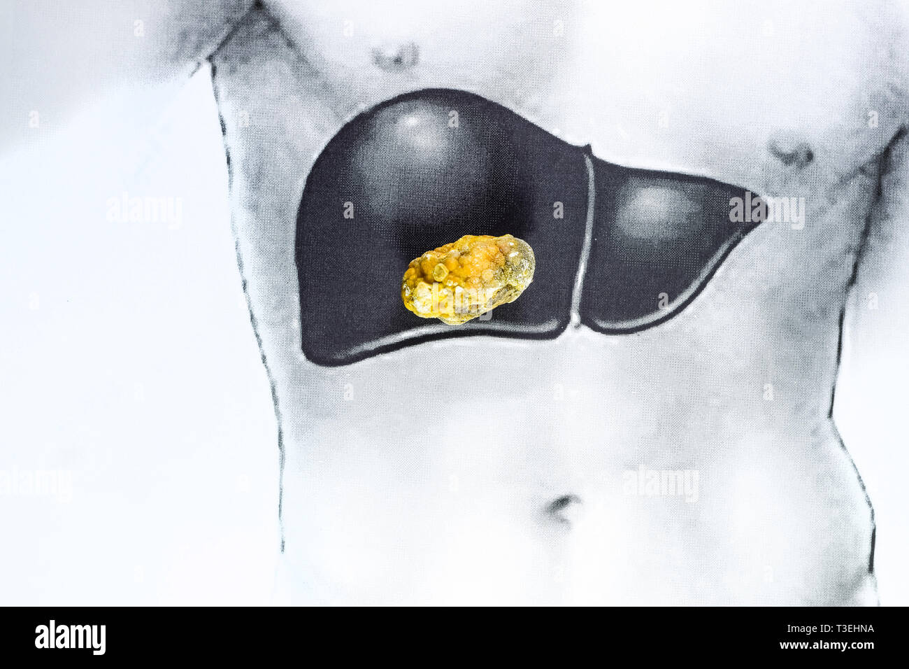 Pietra nel fegato, una immagine schematica, una grande gallstone, il risultato dei calcoli biliari. Foto Stock