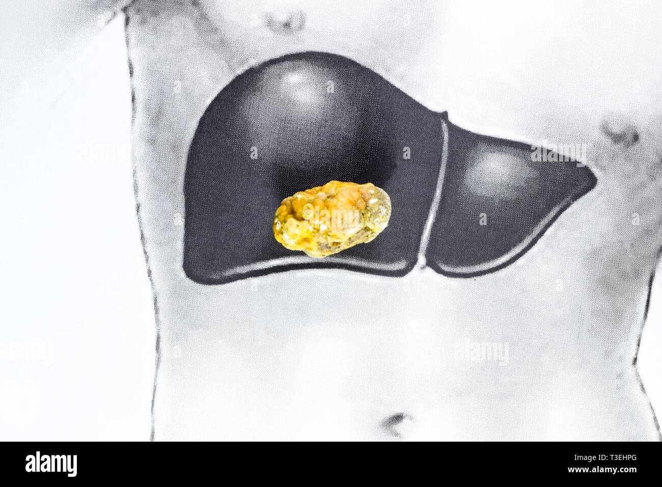 Pietra nel fegato, una immagine schematica, una grande gallstone, il risultato dei calcoli biliari. Foto Stock