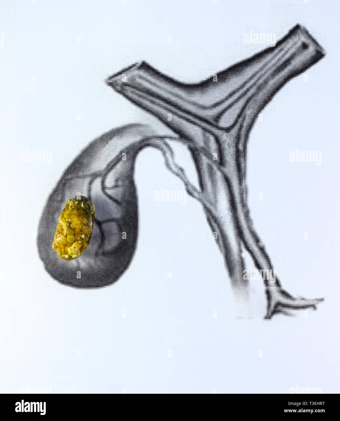 La cistifellea pietre, rappresentazione schematica di grandi dimensioni, Gallstone risultato di malattia gallstone. Foto Stock