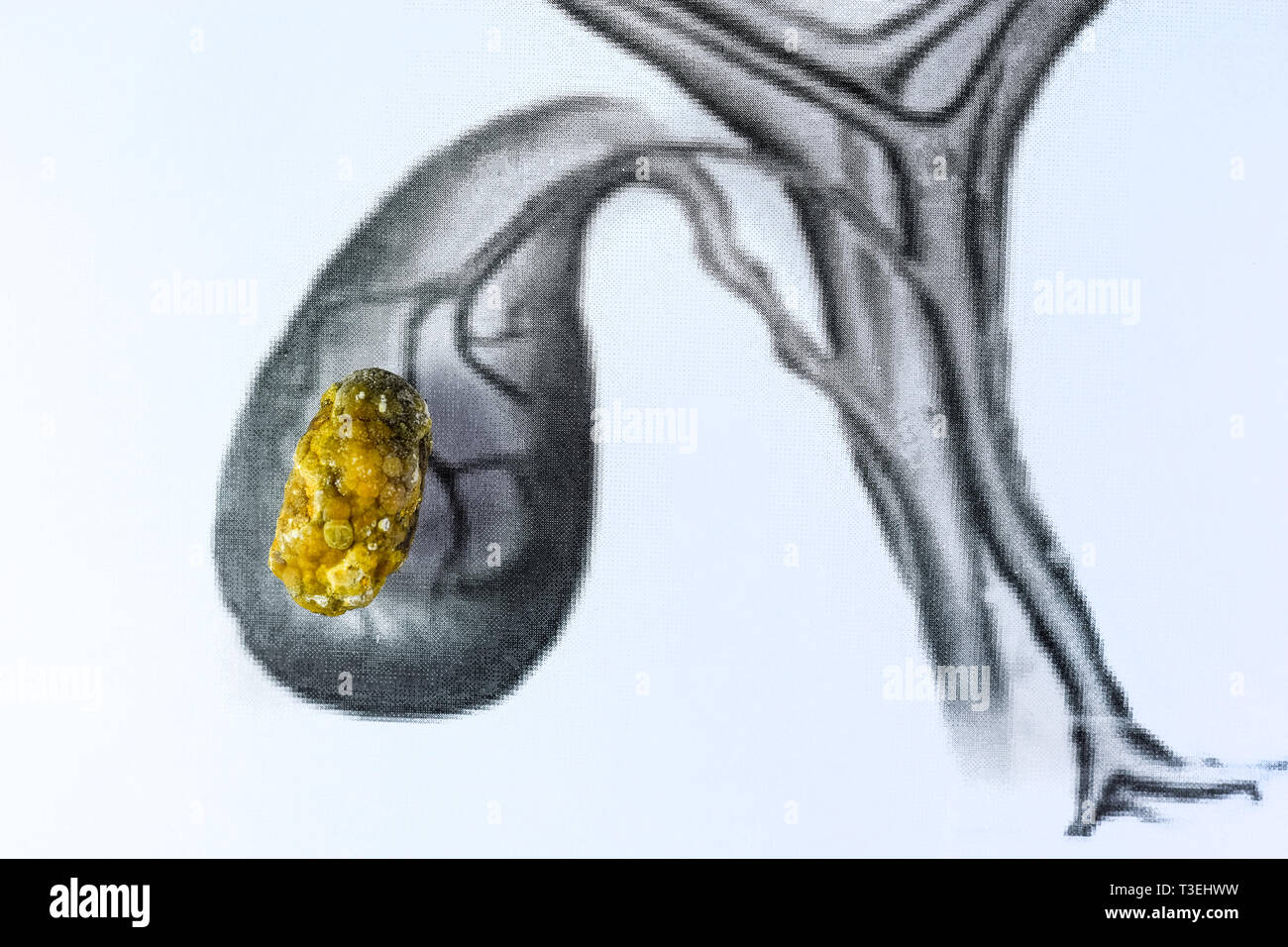 La cistifellea pietre, rappresentazione schematica di grandi dimensioni, Gallstone risultato di malattia gallstone. Foto Stock
