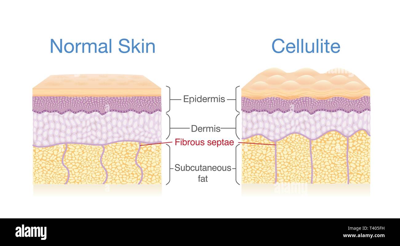 Illustrazione per confrontare il normale strato di pelle e pelle con cellulite. Illustrazione Vettoriale