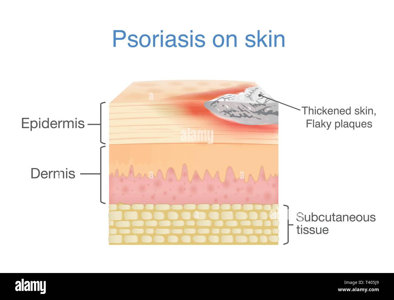 Illustrazione della pelle umana quando lo strato di psoriasi a placche i segni e i sintomi appaiono. Illustrazione Vettoriale