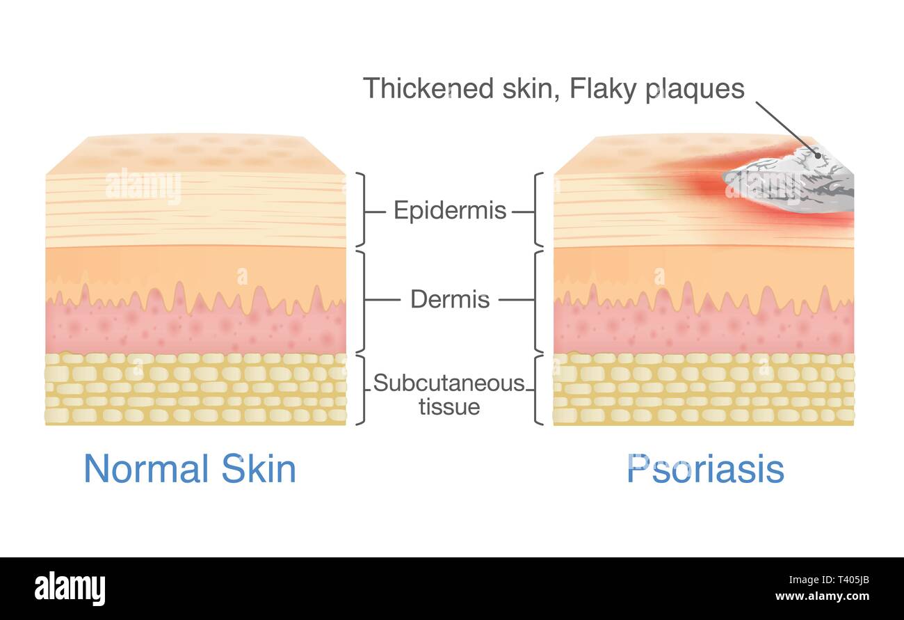 Il normale strato di pelle e pelle quando psoriasi a placche i segni e i sintomi appaiono. illustrazione circa la dermatologia schema. Illustrazione Vettoriale