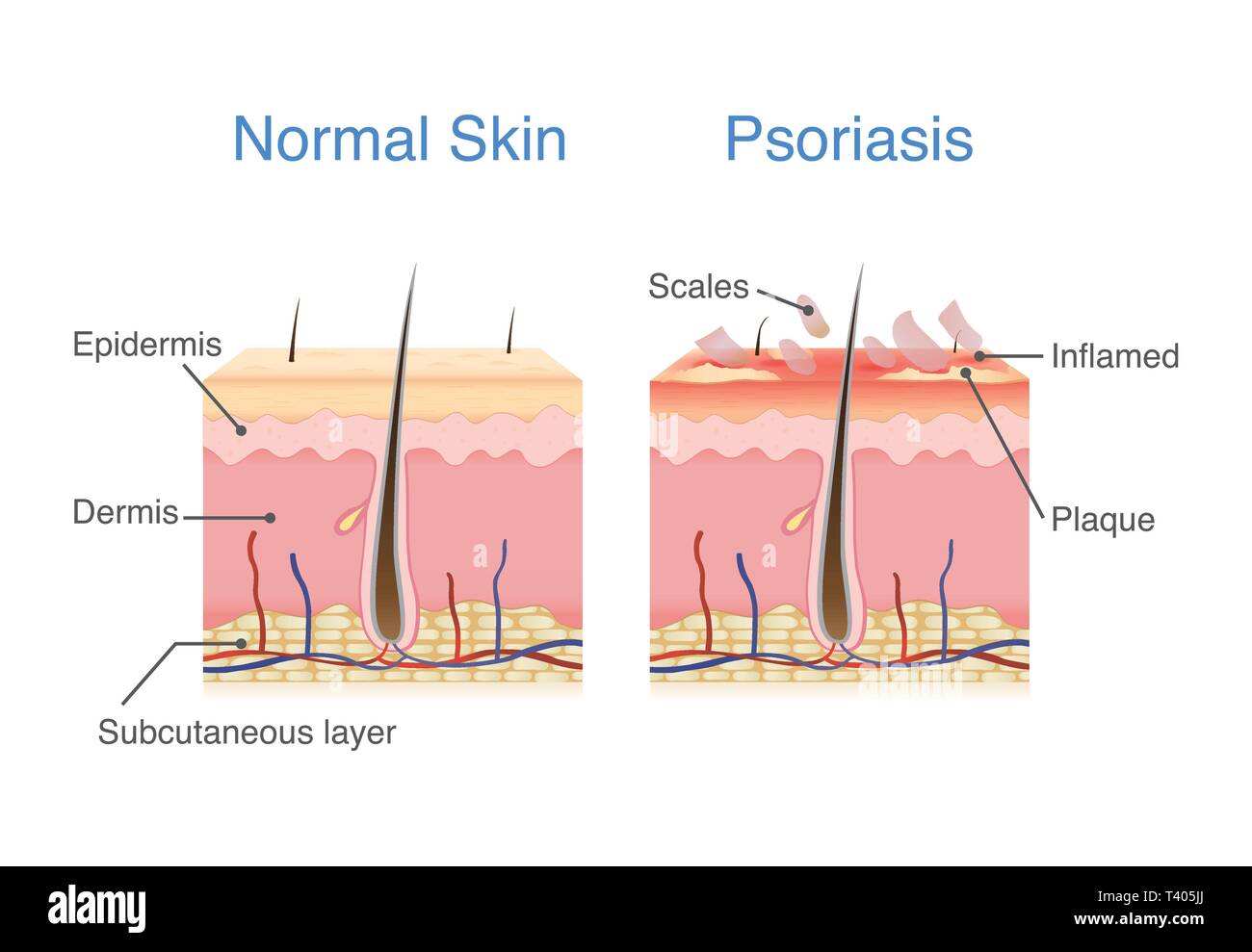 Il normale strato di pelle e pelle quando psoriasi a placche i segni e i sintomi appaiono. Illustrazione Vettoriale