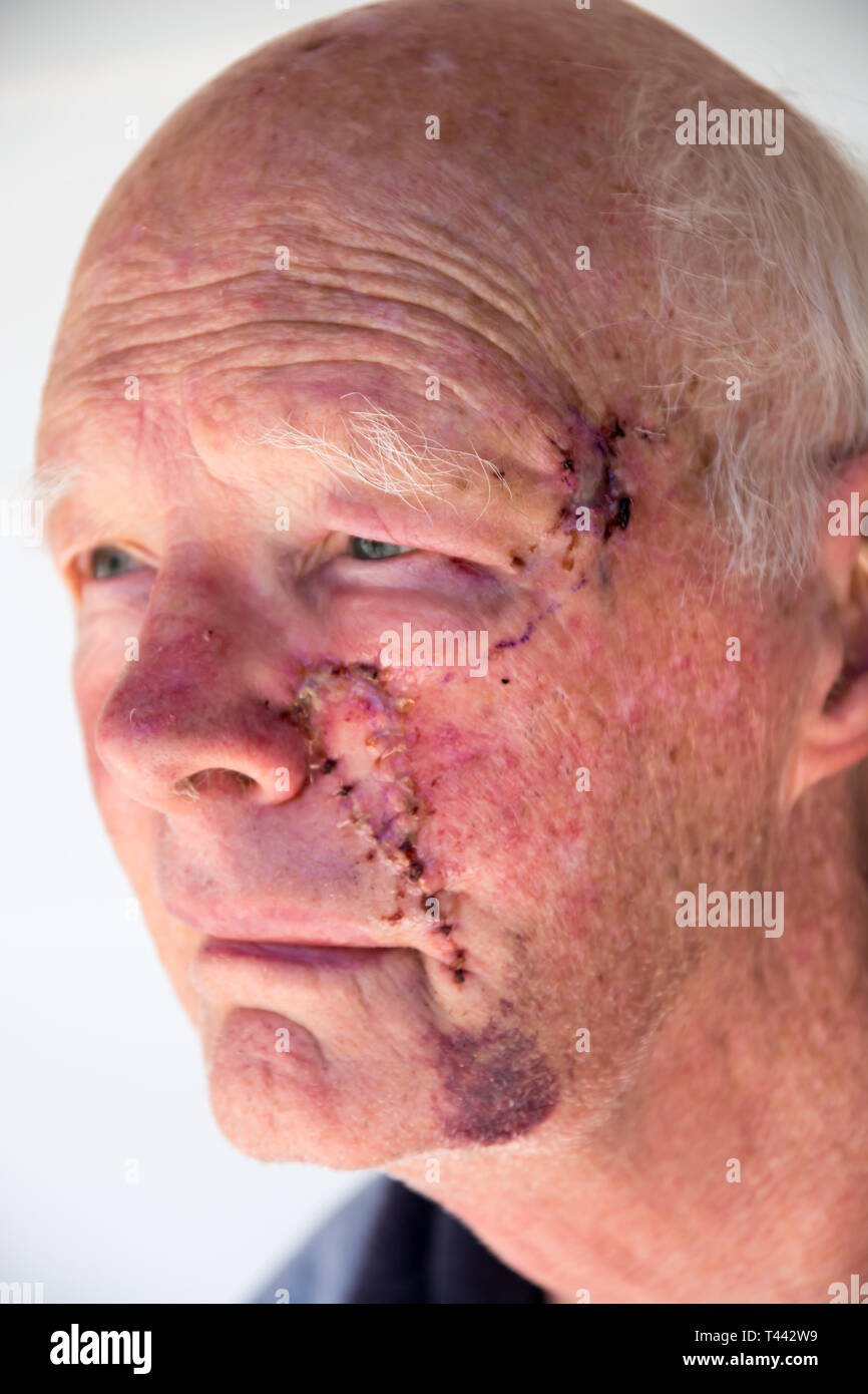 Anziani maschi caucasici un giorno dopo la chirurgia per rimuovere cancri della pelle sulla guancia e tempio. Foto Stock