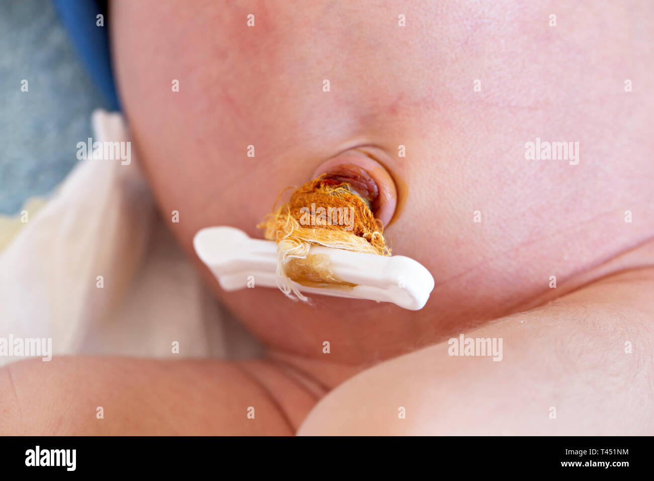 Neonato cordone ombelicale con la fascetta, baby belly button Foto stock -  Alamy