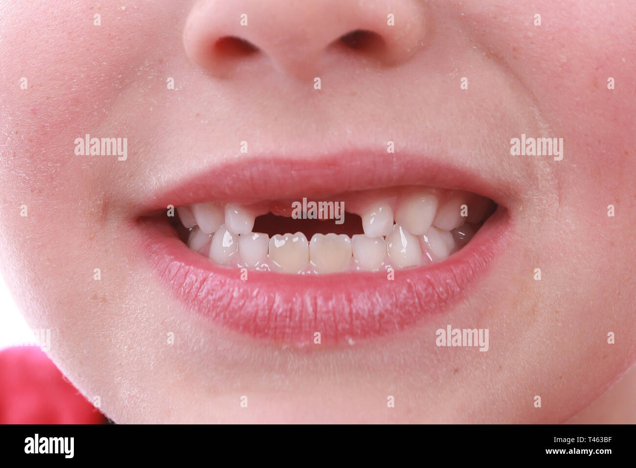 La perdita dei denti, infanzia igiene dentale Foto Stock