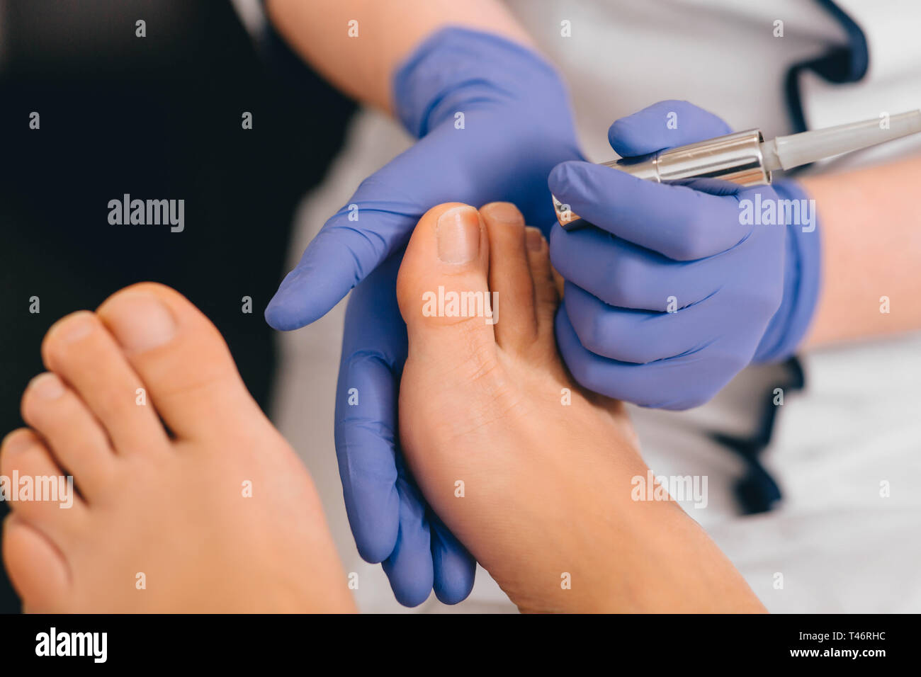 Il trattamento laser su toenail, infezione fungina sulla toenails Foto Stock