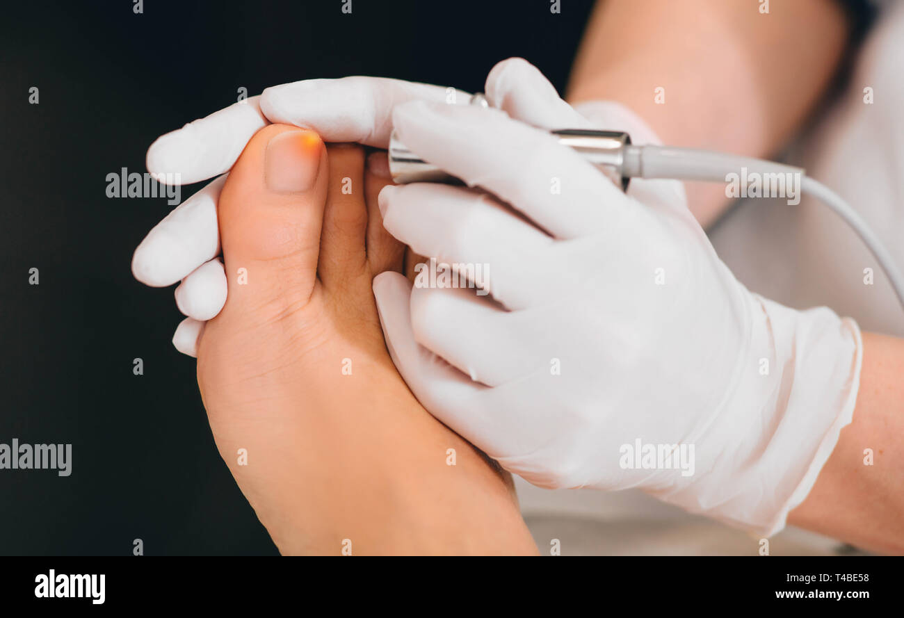Il trattamento laser su toenail, infezione fungina sulla toenails Foto Stock