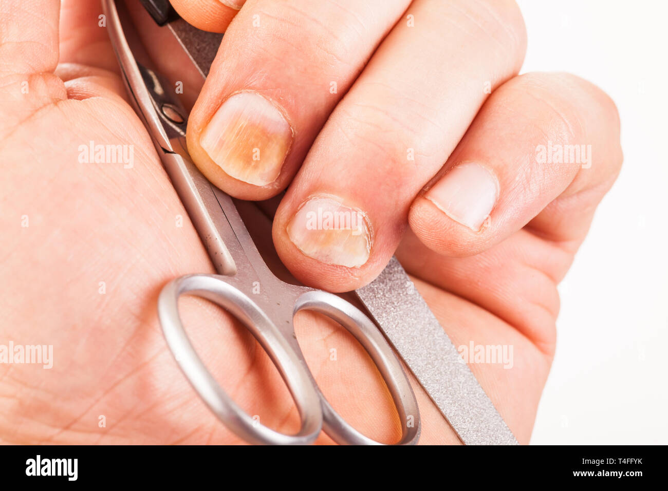 Le unghie con chiodo fungo Foto Stock