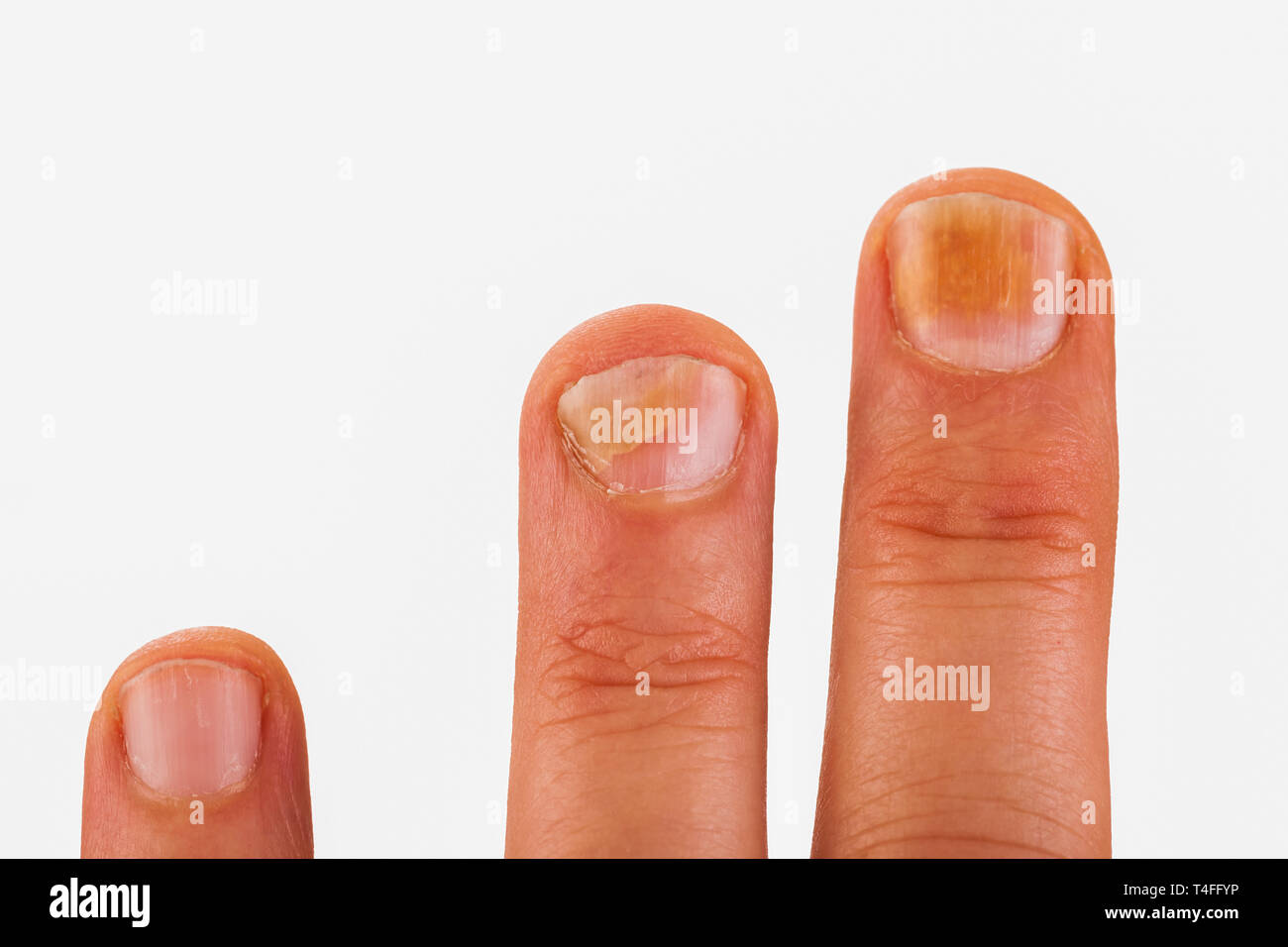 Le unghie con chiodo fungo Foto Stock