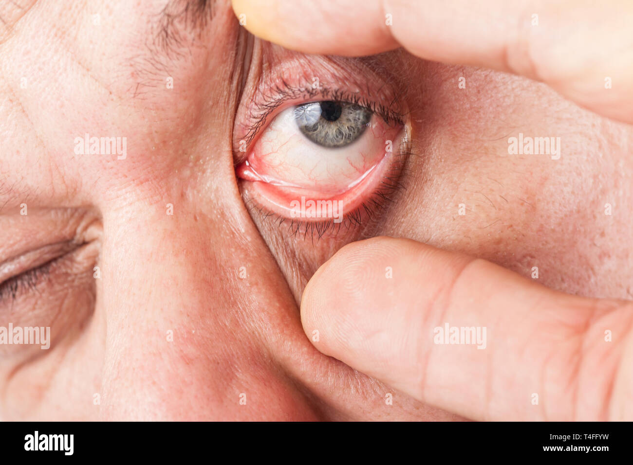 Un uomo di allargare il suo occhio con pollice e indice Foto Stock