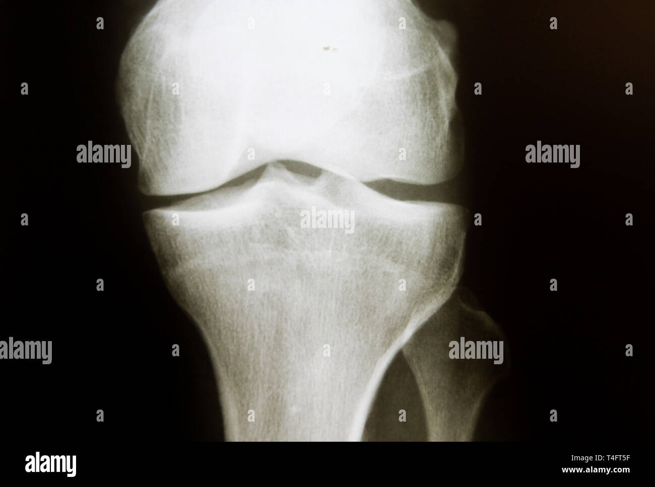 Immagine a raggi X del sano ginocchio regolari con la normale comune spazio (risultati negativi) Foto Stock