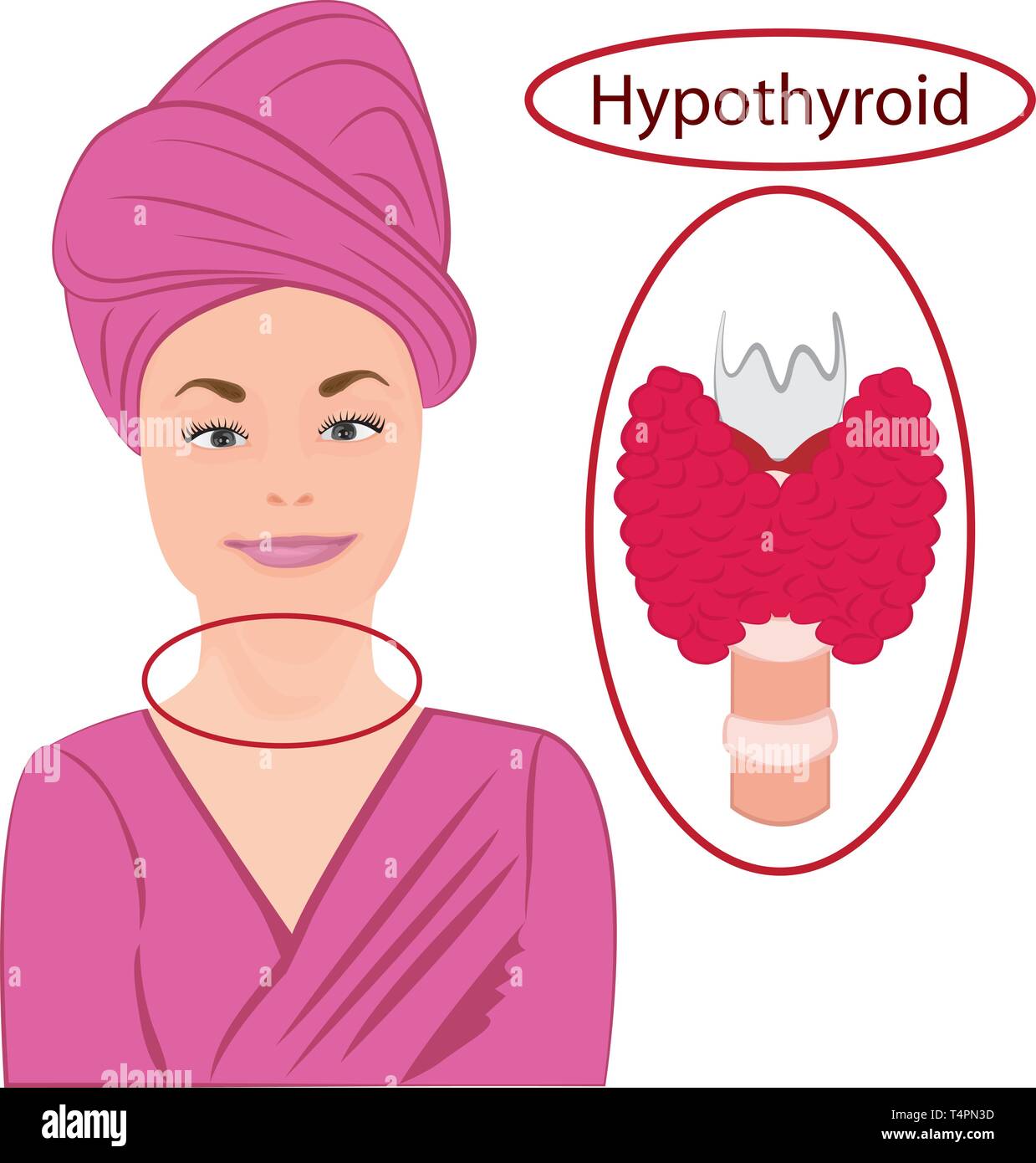 Gozzo. Tiroide ingrandita. La disfunzione endocrina illustrazione vettoriale su sfondo bianco Illustrazione Vettoriale