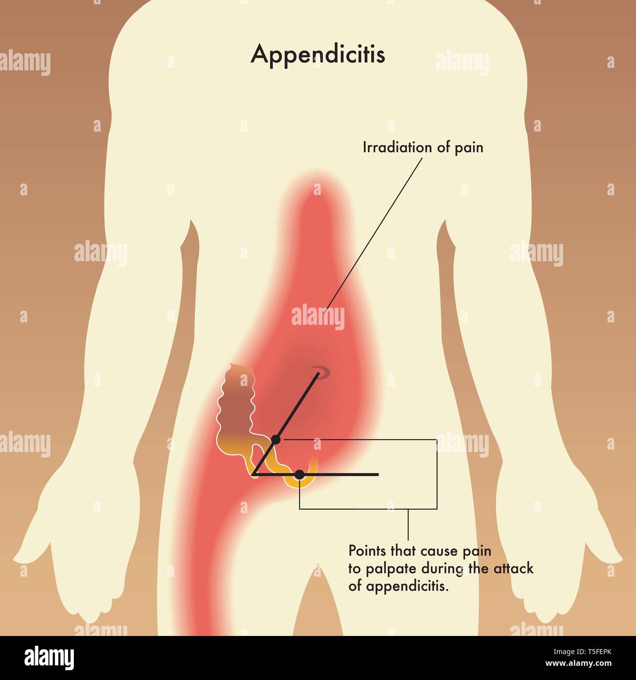 Medical illustrazione che mostra i punti che possono causare dolore per palpare durante l attacco di appendicite. Illustrazione Vettoriale