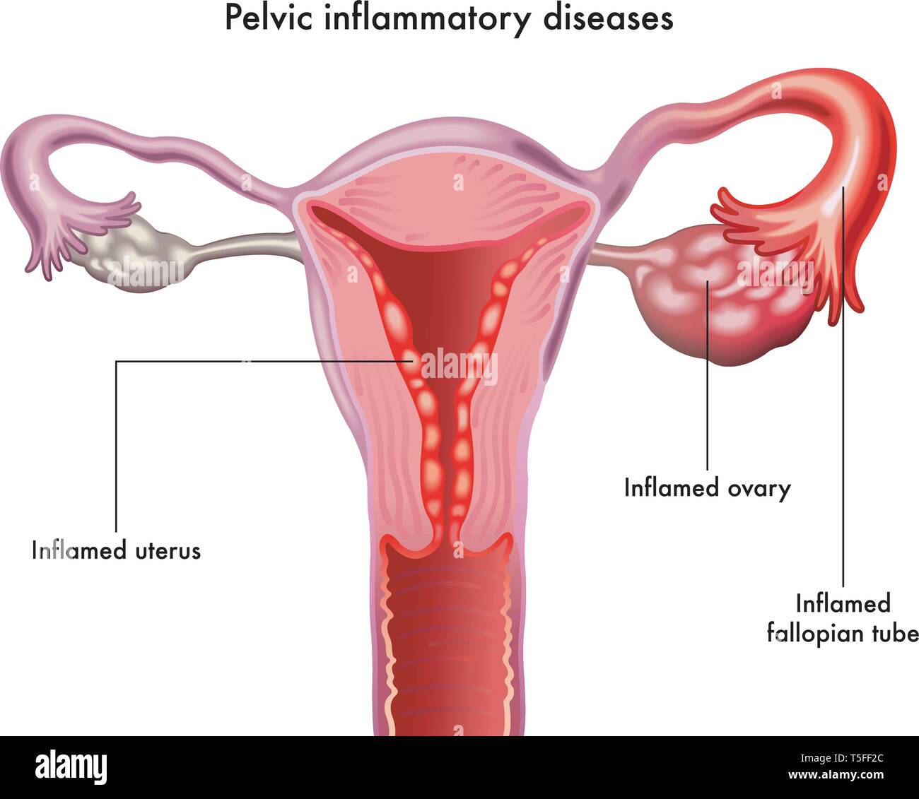 Pelvica malattie infiammatorie illustrato in forma anatomica su bianco. Illustrazione Vettoriale