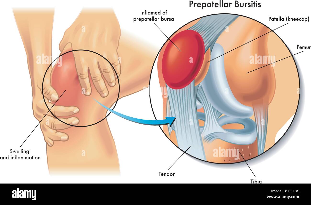 Illustrazione medica mostra anatomia della borsite prepatellar condizione del ginocchio umano. Illustrazione Vettoriale