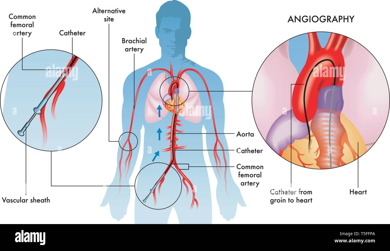 Etichettati illustrazione di angiografia coronarica operazioni sul maschio adulto, sfondo bianco. Illustrazione Vettoriale