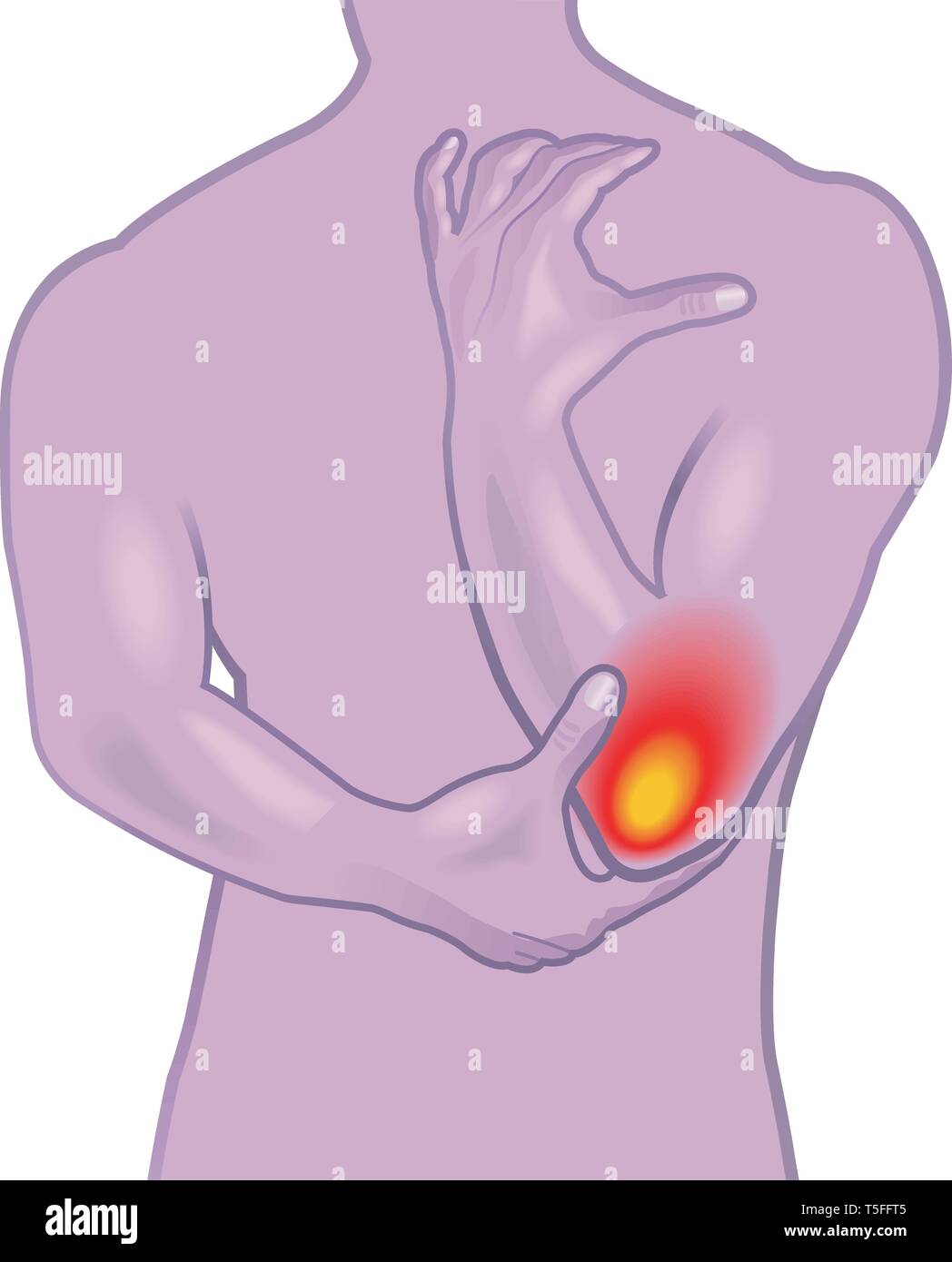 Una illustrazione medica dei sintomi del dolore a gomito o il gomito del tennista, noto anche come epicondiliti. Illustrazione Vettoriale