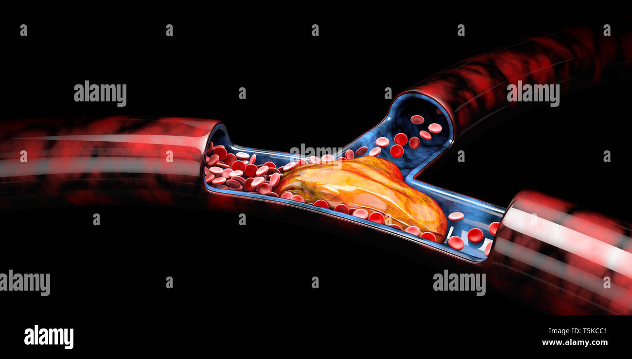 3d illustrazione di trombosi venosa profonda o coaguli di sangue, embolia nero isolato. Foto Stock