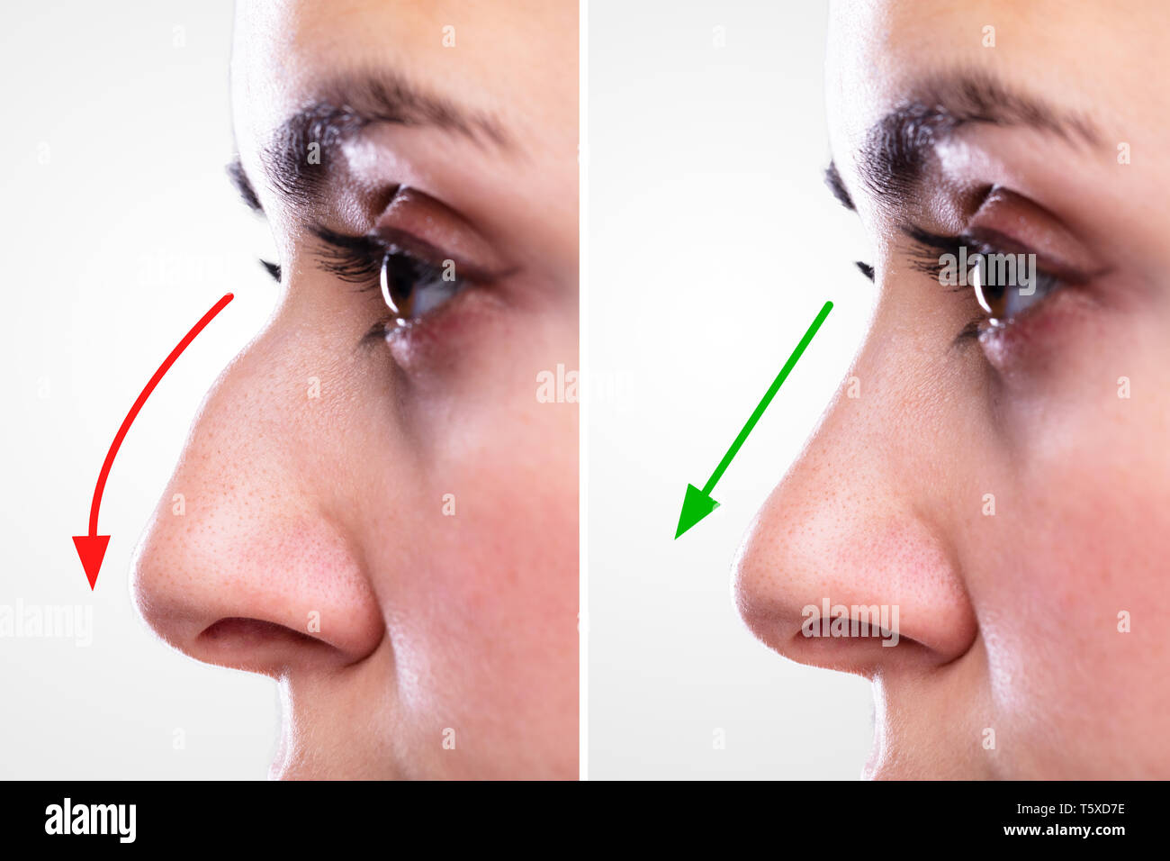 Donna di naso prima e dopo un intervento di chirurgia plastica con le  frecce rosse e verdi Foto stock - Alamy