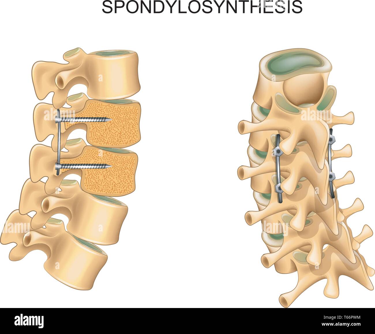 Illustrazione vettoriale di spondylosynthesis. osteosintesi vertebrale chirurgia. Illustrazione Vettoriale