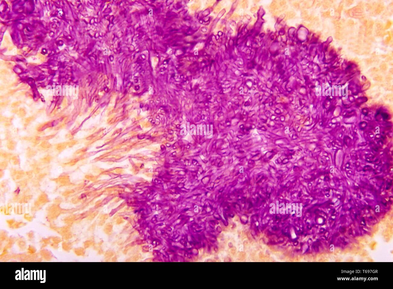 Macchia Gridley microfotografia dell'aspetto istopatologica del grano nero mycetoma causato dalla Madurella mycetomatis fungo, 1972. Immagine cortesia di centri per il controllo e la prevenzione delle malattie (CDC) / Dr Libero Ajello. () Foto Stock