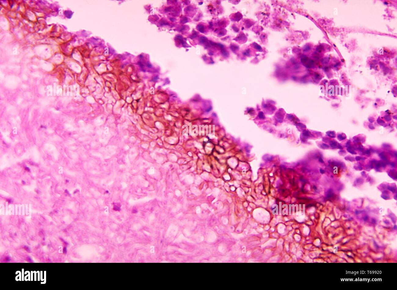 La fotomicrografia della variazioni istopatologiche in grano nero mycetoma causate da funghi Madurella grisea, 1970. Immagine cortesia di centri per il controllo e la prevenzione delle malattie (CDC) / Dr Libero Ajello. () Foto Stock