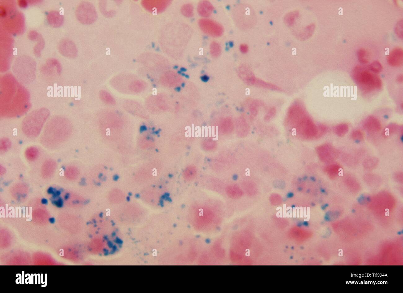 Una fotomicrografia rilevando la presenza di emosiderina, colorate in blu, all'interno di diffondere il midollo osseo, 1972. L'emosiderina, qui rivelata impiegando PAS macchia e HandE counterstain, è un normale sottoprodotto prodotte durante la rottura dei globuli rossi e la decomposizione della molecola di emoglobina contenuta in questi componenti del sangue. Immagine cortesia CDC/Dott. Gordon D. McLaren. Foto Stock