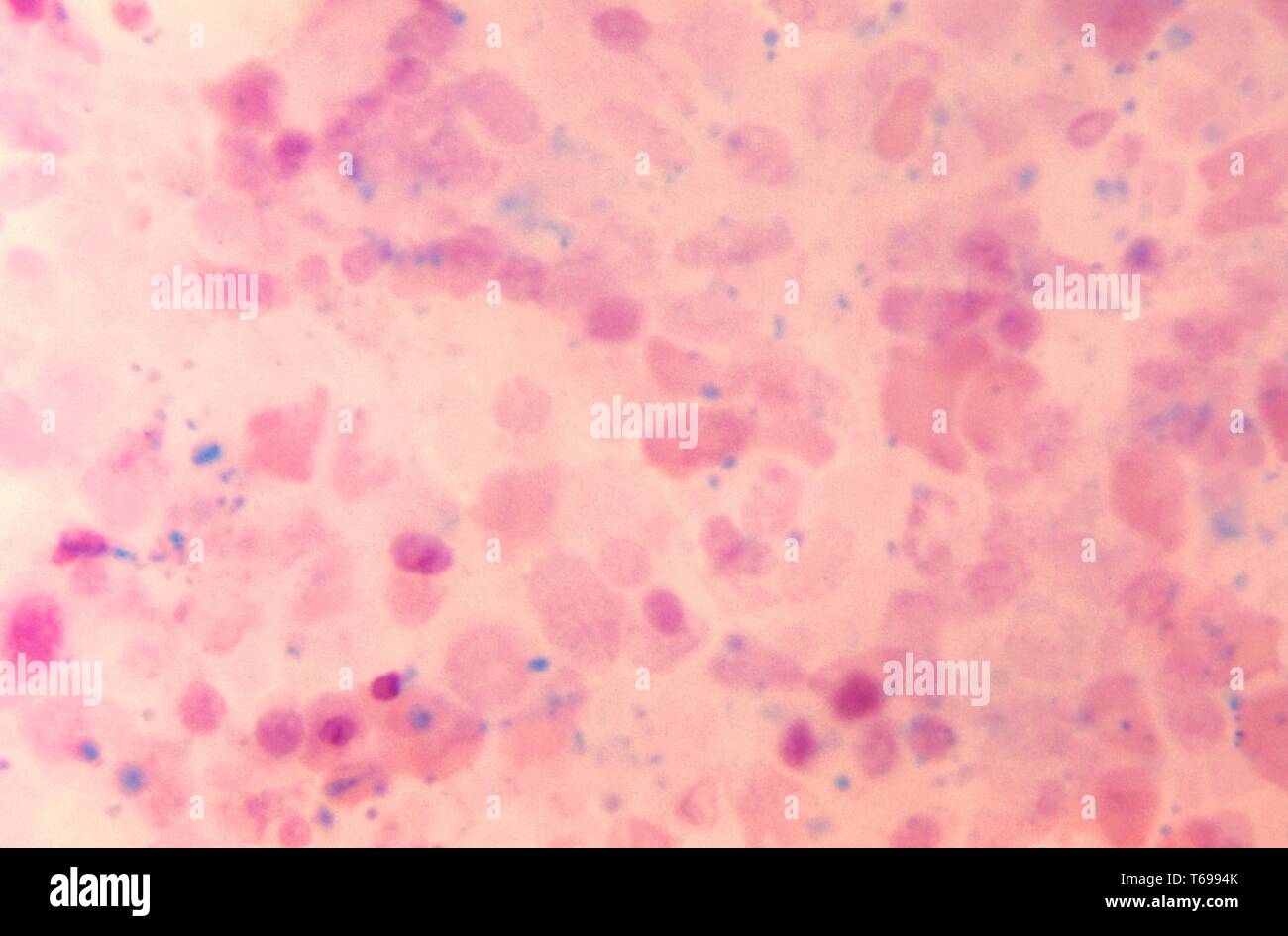 Una fotomicrografia rilevando la presenza di emosiderina, colorate in blu, all'interno di diffondere il midollo osseo, 1972. L'emosiderina, qui rivelata impiegando PAS macchia e HandE counterstain, è un normale sottoprodotto prodotte durante la rottura dei globuli rossi e la decomposizione della molecola di emoglobina contenuta in questi componenti del sangue. Immagine cortesia CDC/Dott. Gordon D. McLaren. Foto Stock