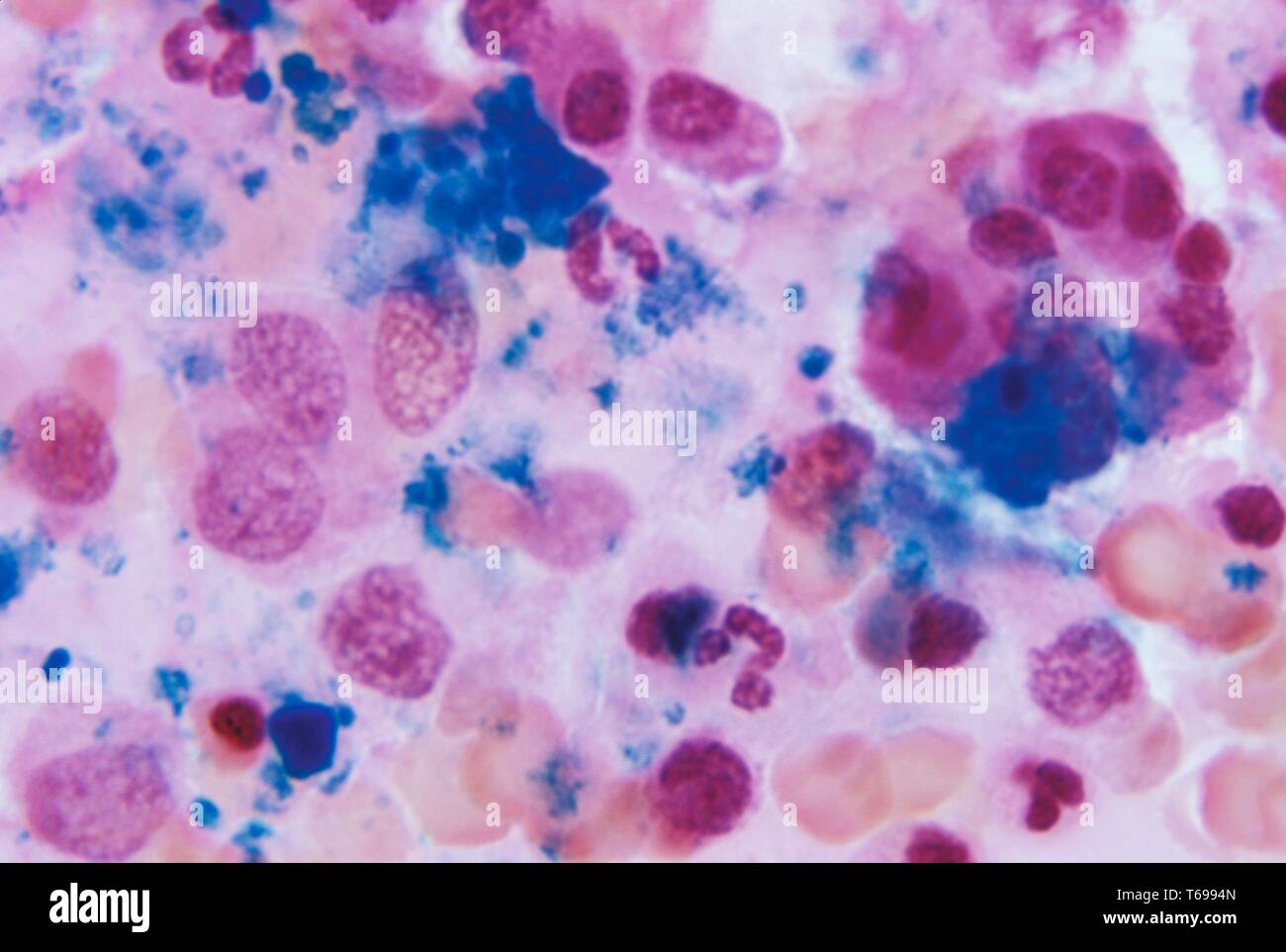 La microfotografia di il tessuto del midollo osseo mostra una normale quantità di ferro negozi utilizzando blu di Prussia macchia, 1972. Normali negozi di ferro sono visti come blu scuro-materiale macchiante nel midollo osseo. Una persona che non sia in grado di mantenere un equilibrato, ricche di ferro e la dieta può soffrire di qualche grado di anemia da deficienza di ferro, o IDA. Immagine cortesia CDC/Dott. Gordon D. McLaren. Foto Stock