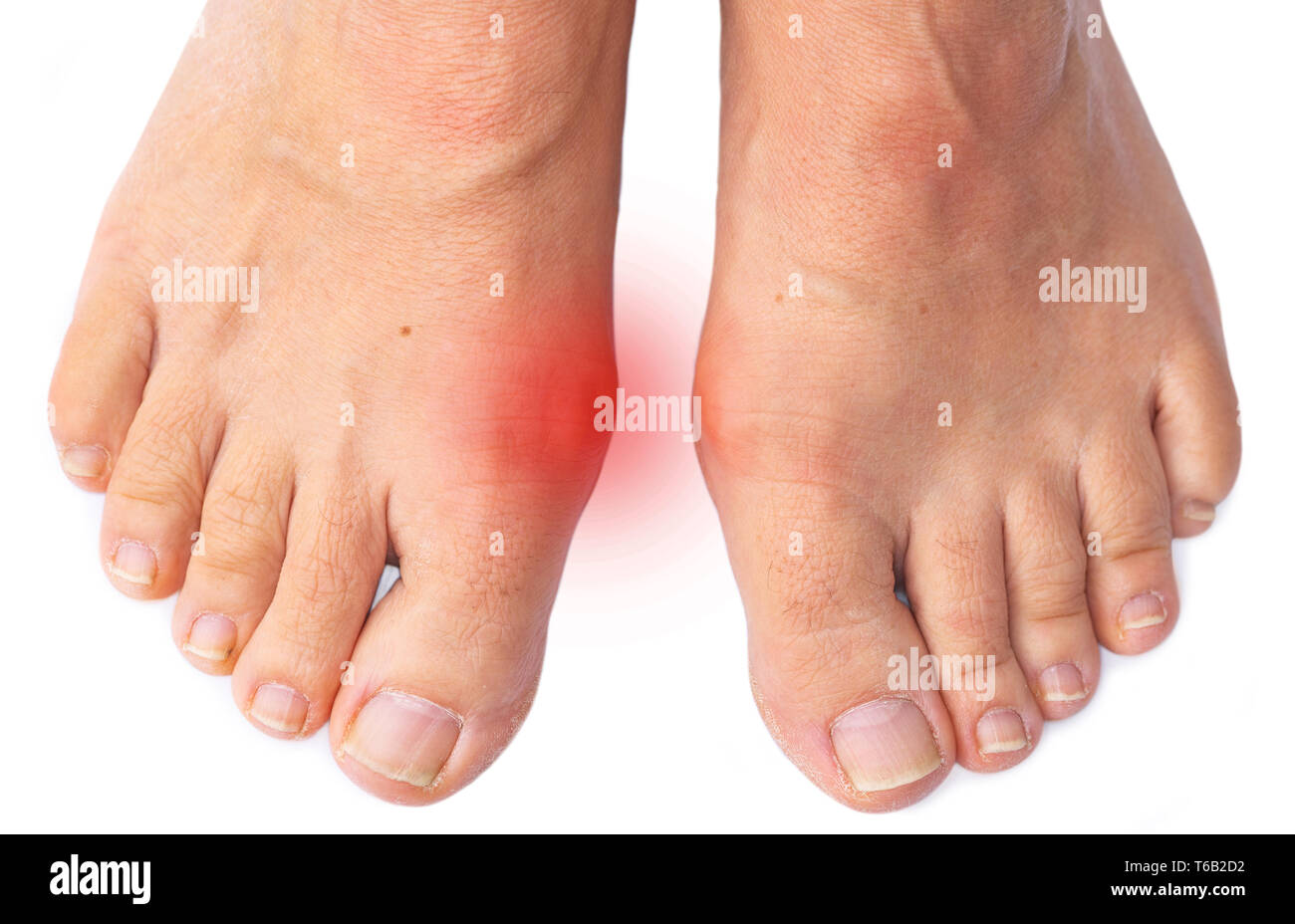 I piedi di una donna con dolorose alluce valgo Foto Stock