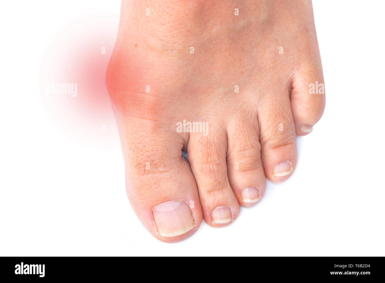 Il piede di una donna con dolorose alluce valgo Foto Stock