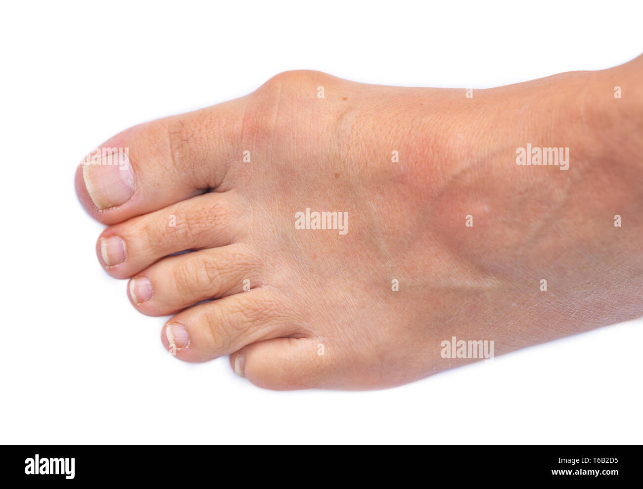 Il piede di una donna con dolorose alluce valgo Foto Stock