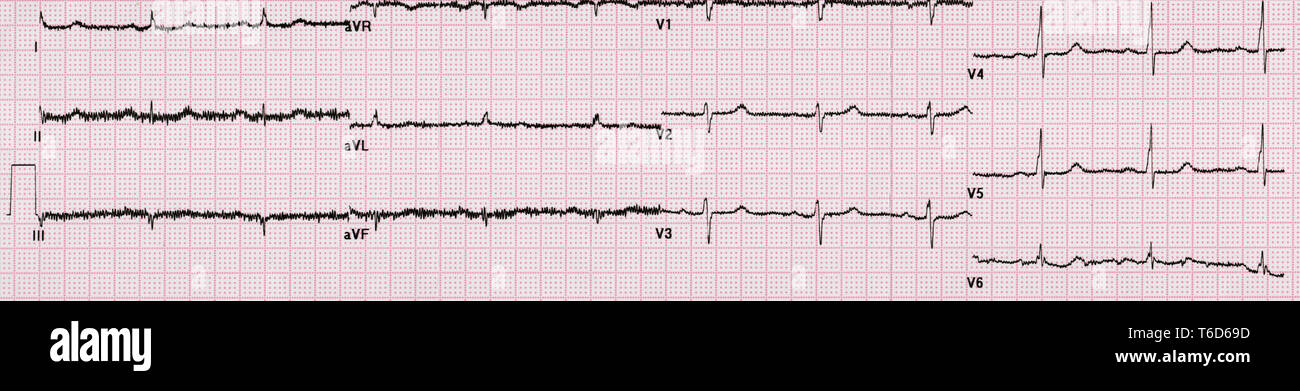 Curvi linea elettrocardiogramma Foto Stock