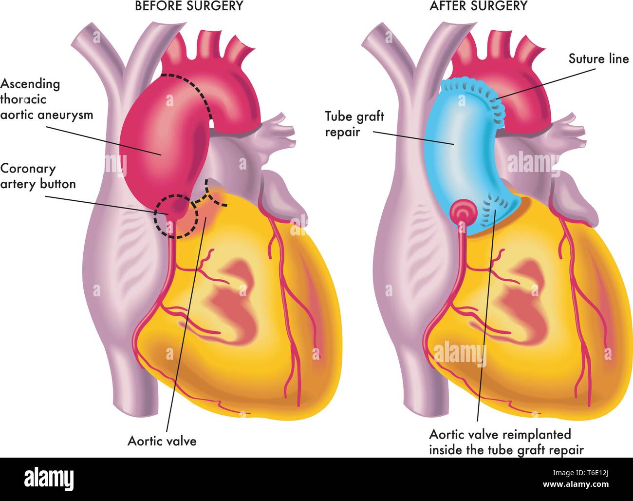 Illustrazione medica di un aneurisma aortico toracico chirurgia Illustrazione Vettoriale