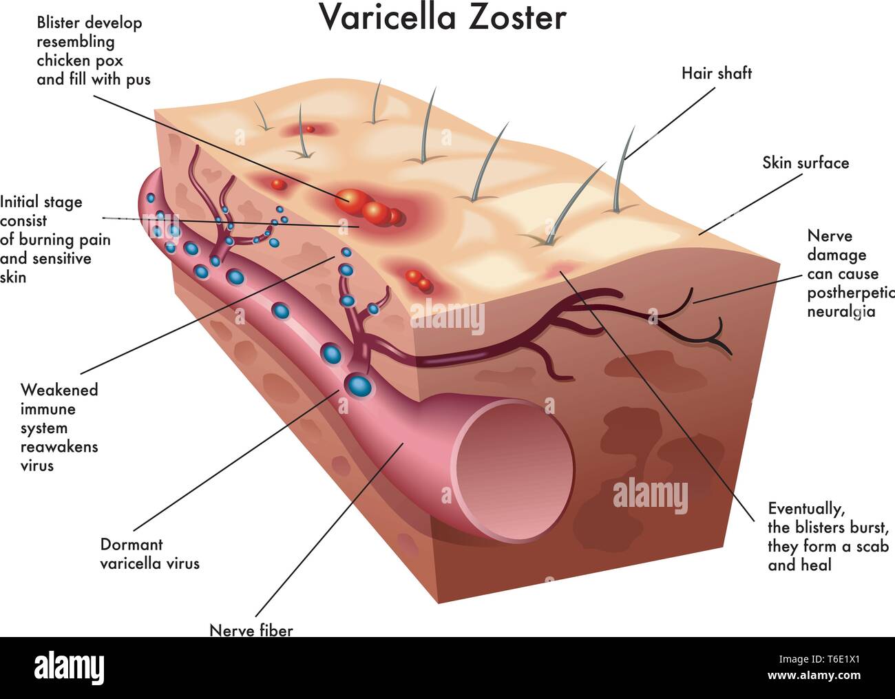 Illustrazione medica del virus di varicella zoster Illustrazione Vettoriale