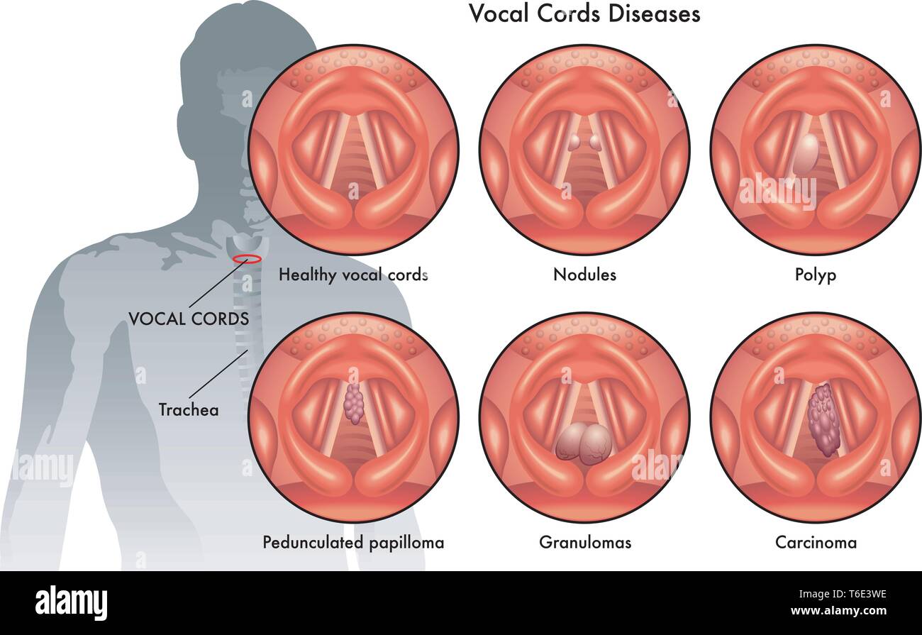Illustrazione medica delle corde vocali le malattie Illustrazione Vettoriale