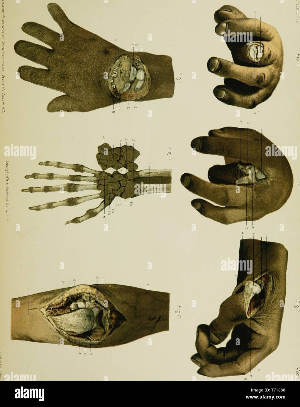 Illustrazioni di Anatomia delle ossa metacarpali, dal libro "anatomia regionale nella sua relazione alla medicina e chirurgia' da George McClellan, 1891. La cortesia Internet Archive. () Foto Stock