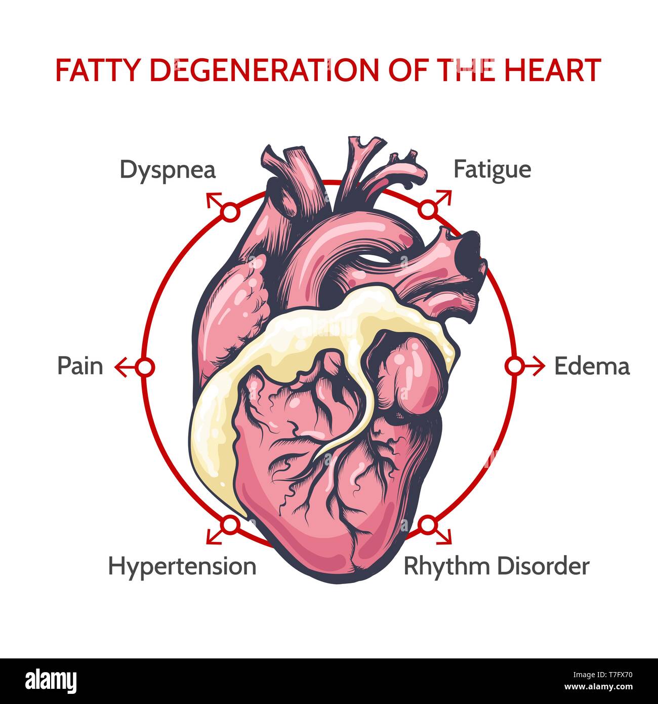 Degenerazione grassa del cuore. Principali sintomi della malattia. Cardiologia medica illustrazione vettoriale. Illustrazione Vettoriale