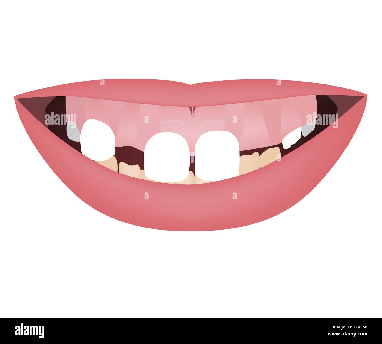 I ragazzi di ganasce con sorriso gommoso, crooked denti inferiori e morso distale prima della orthotropics o trattamento orthotropics. Illustrazione Vettoriale Illustrazione Vettoriale