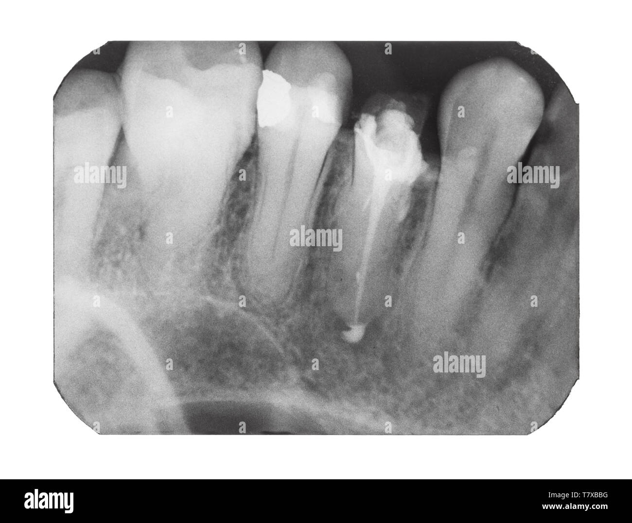 Film con immagine a raggi X dei denti umani con perno odontoiatrico isolati su sfondo bianco Foto Stock