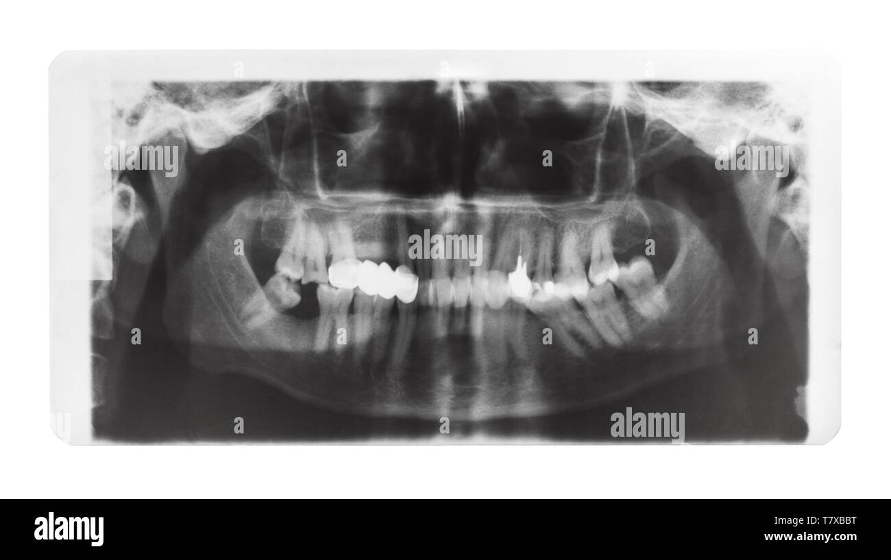Film con immagine a raggi X di ganasce umana con la corona dentale e perni in denti isolati su sfondo bianco Foto Stock